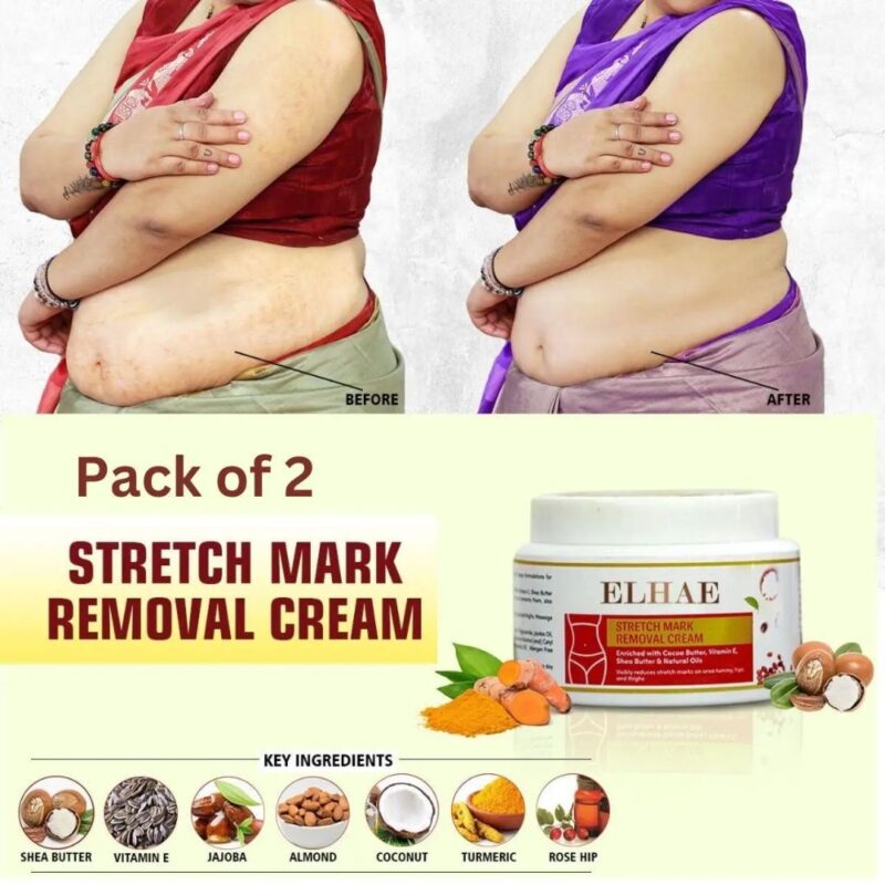 Stretch Mark Removal Cream